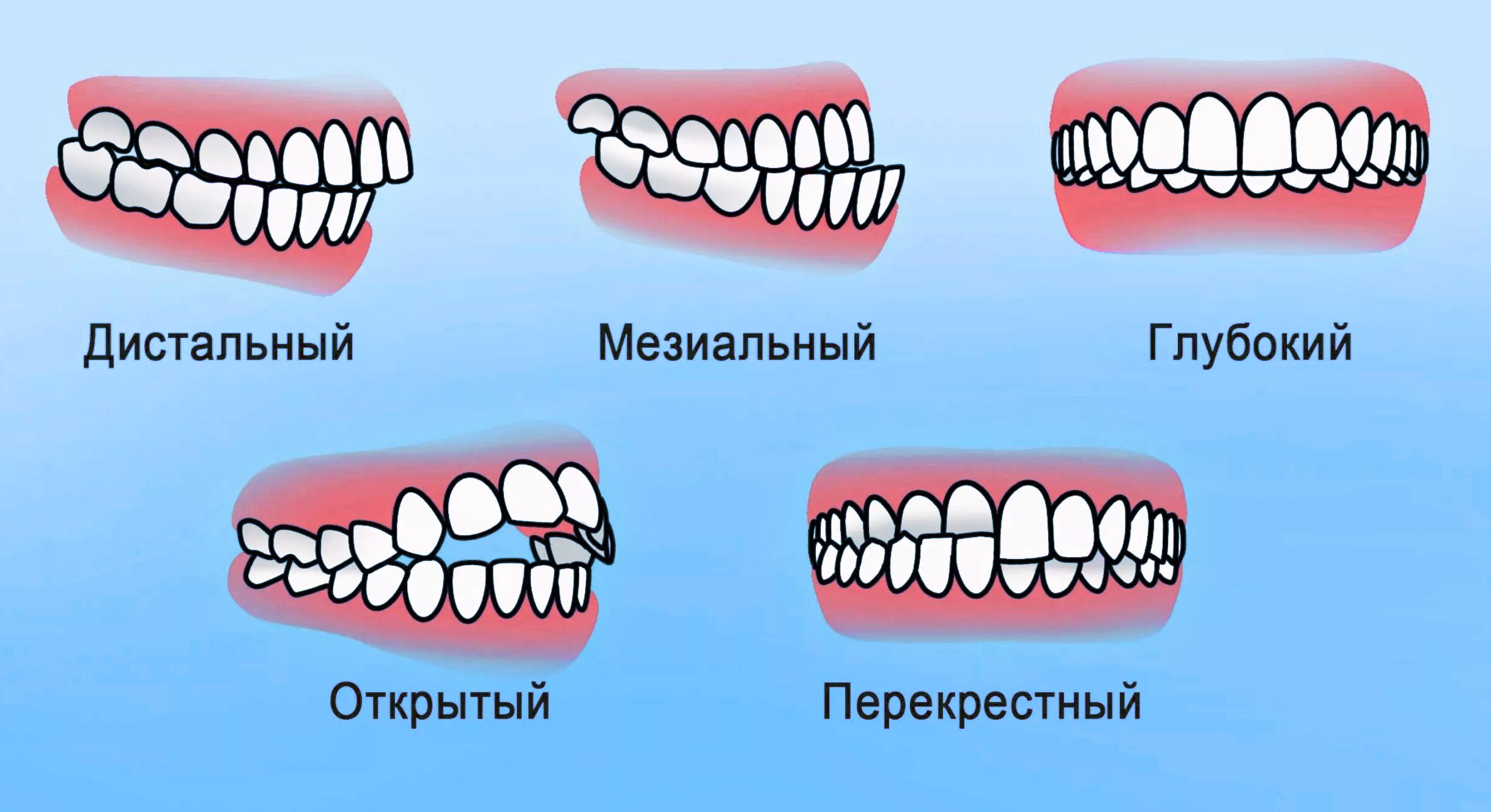 Виды зубного прикуса. Правильный и неправильный прикус и челюсть.